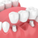 Dental Implant Versus Bridge/Crown- which is better?