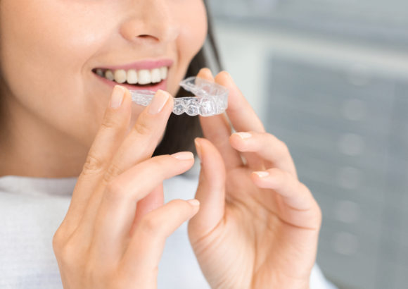 Clear Aligners / Clear Braces